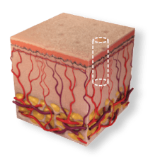 Cross-section of skin showing narrow, deep DeepFX CO2 laser columns reaching the collagen layer