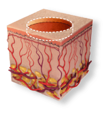 Cross-section of skin showing a wide, shallow MaxFX CO2 laser treatment of the surface layer