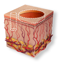 Cross-section of skin showing TotalFX combining shallow surface and deep CO2 laser treatment