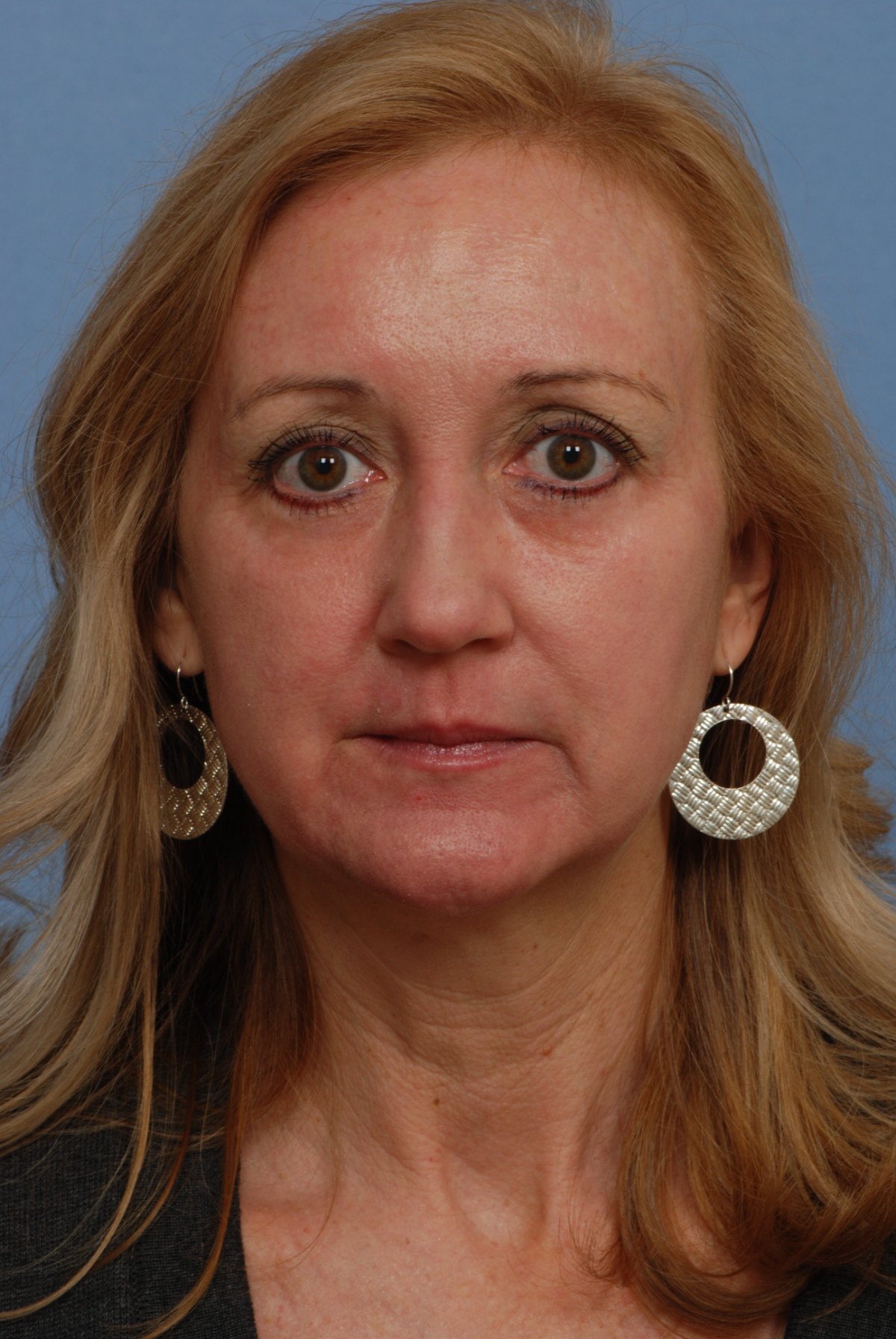 One month after CO2 laser skin resurfacing, front view