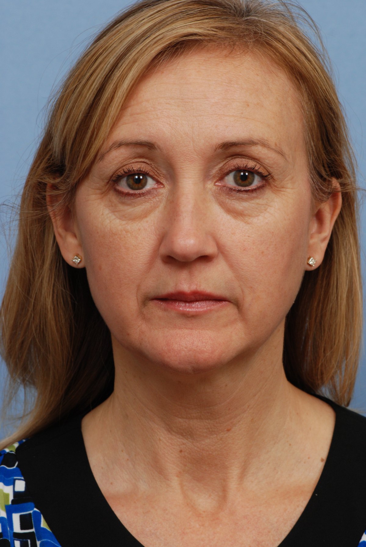 Patient before CO2 laser skin resurfacing, front view