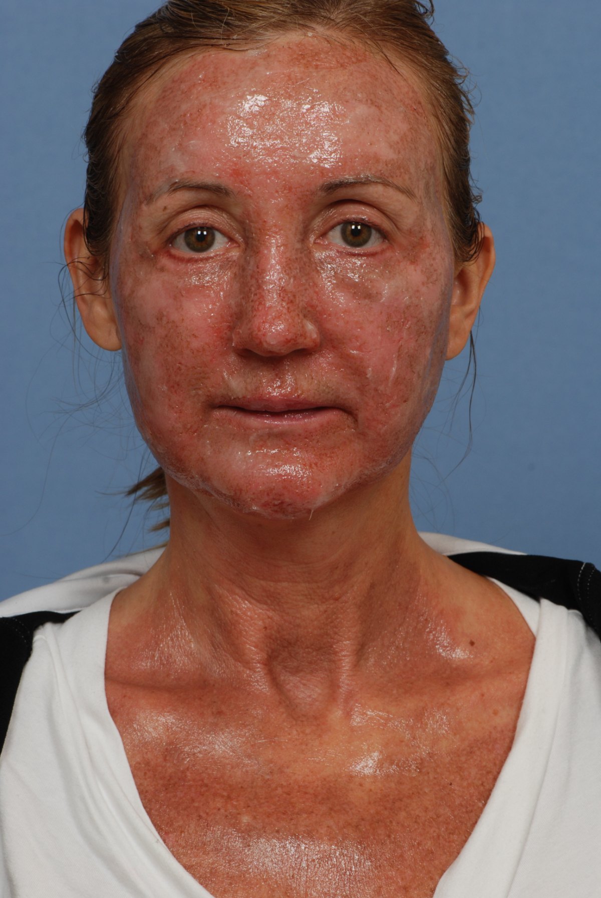 Day 1 of recovery after CO2 laser skin resurfacing, front view