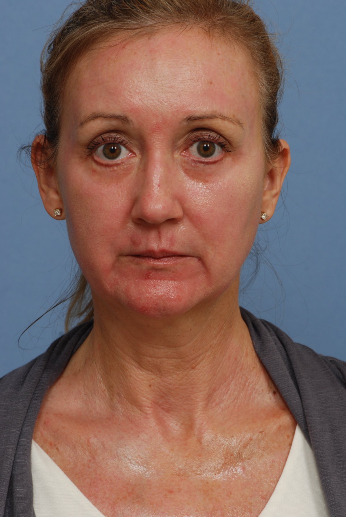 Day 10 of recovery after CO2 laser skin resurfacing, front view