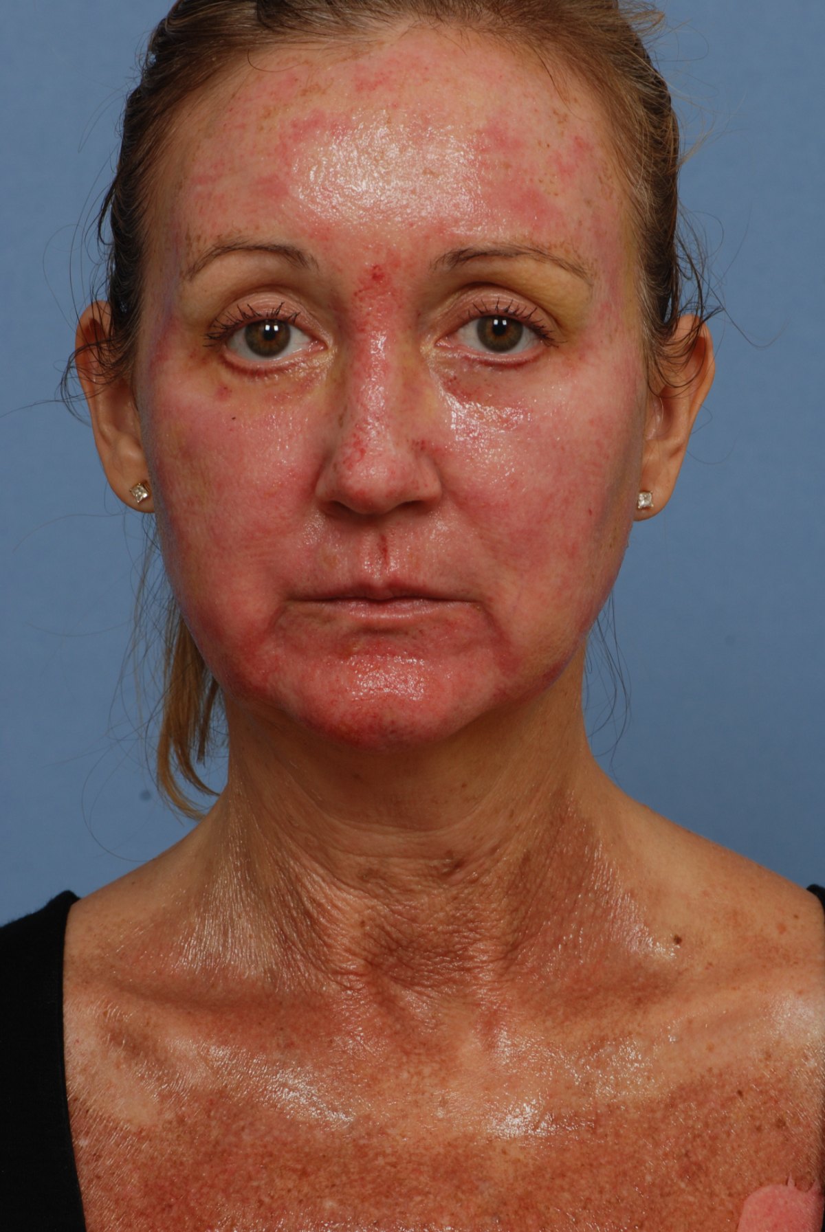 Day 3 of recovery after CO2 laser skin resurfacing, front view