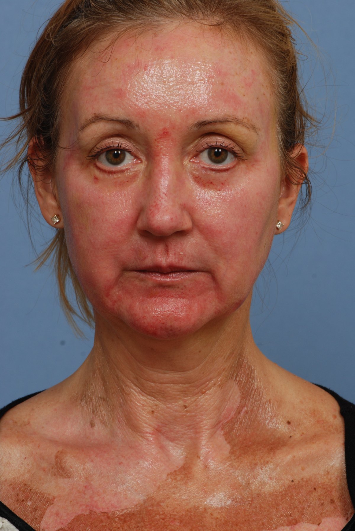 Day 5 of recovery after CO2 laser skin resurfacing, front view