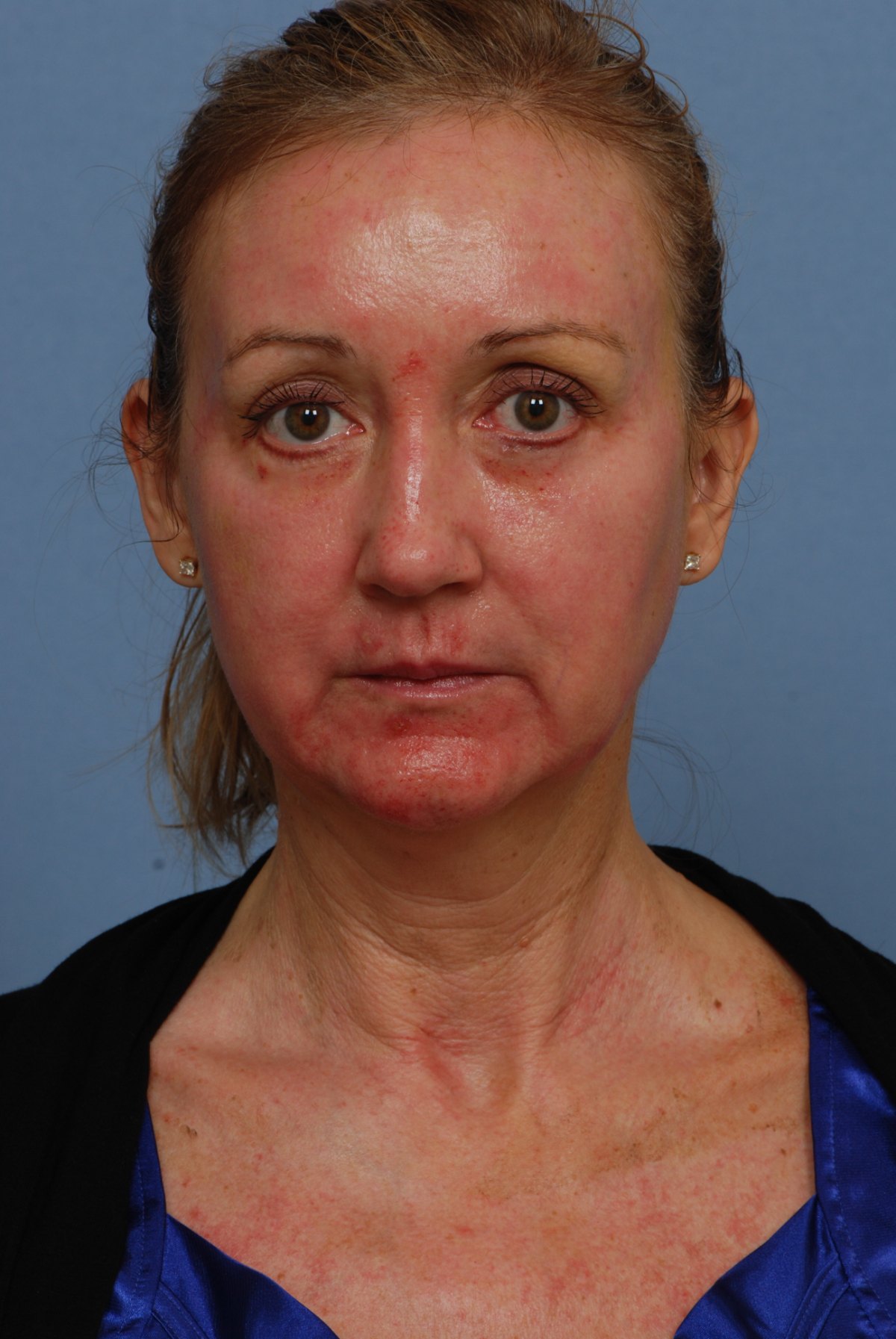 Day 7 of recovery after CO2 laser skin resurfacing, front view