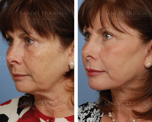 Facelift before and after, actual patient of Dr. Sandel