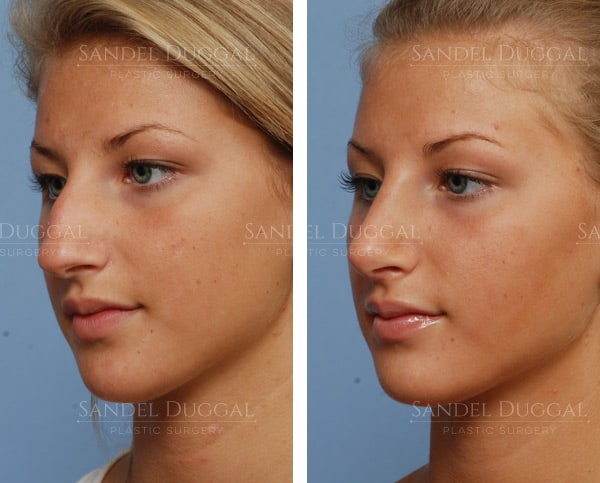 Rhinoplasty before and after, actual patient of Dr. Sandel