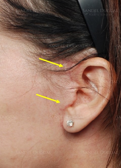Facelift incisions one month after surgery, profile view