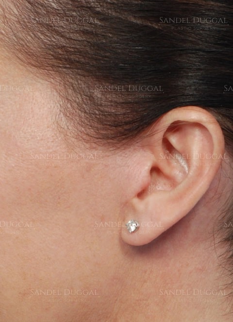 Facelift incisions three months after surgery, profile view