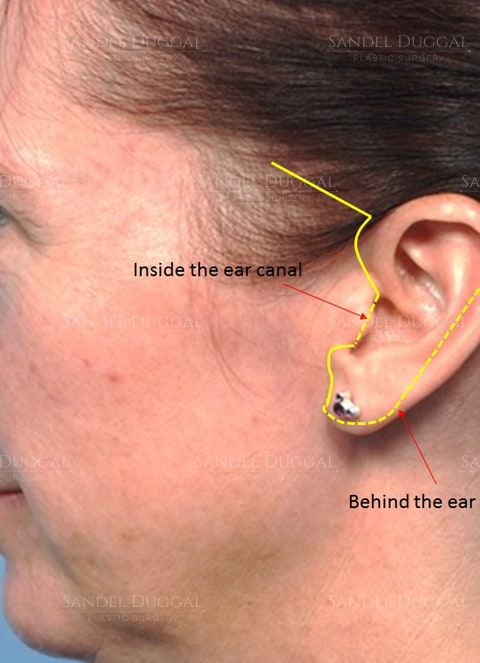 Facelift incision planning marked before surgery