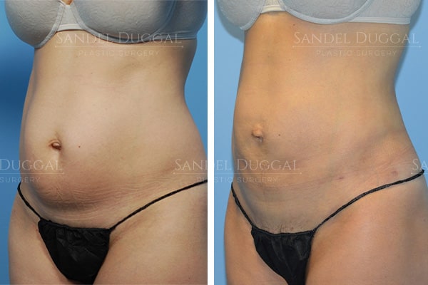 Abdomen liposuction before and after, actual patient of Dr. Duggal