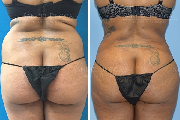 Back liposuction before and after, actual patient of Dr. Duggal