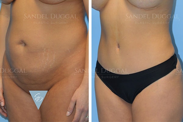 Tummy tuck before and after, actual patient of Dr. Duggal