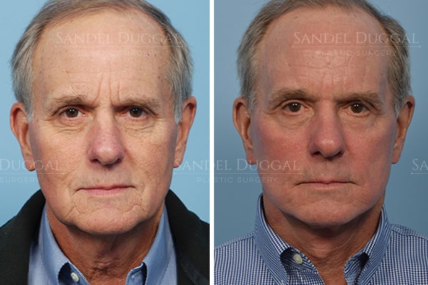 Male facelift before and after, actual patient