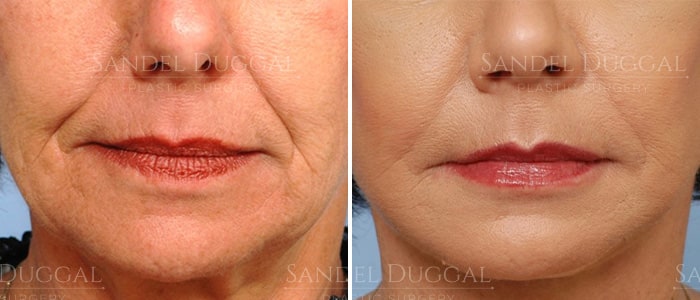 Dermal filler treatment before and after, actual patient
