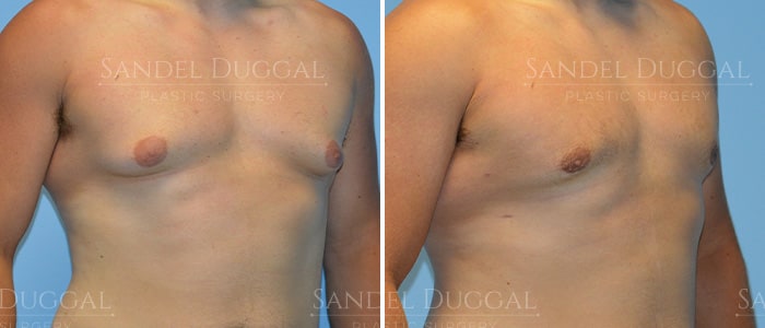 Gynecomastia surgery before and after, actual patient