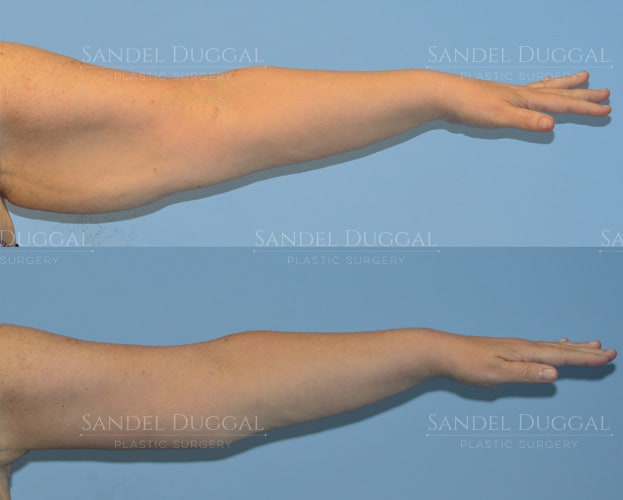 Arm lift before and after, actual patient of Dr. Duggal