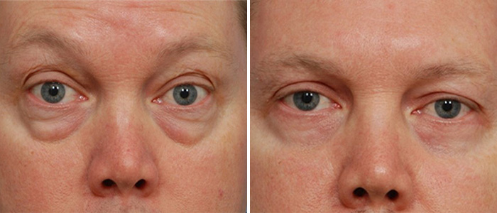 Eyelid surgery before and after — male patient of Dr. Sandel