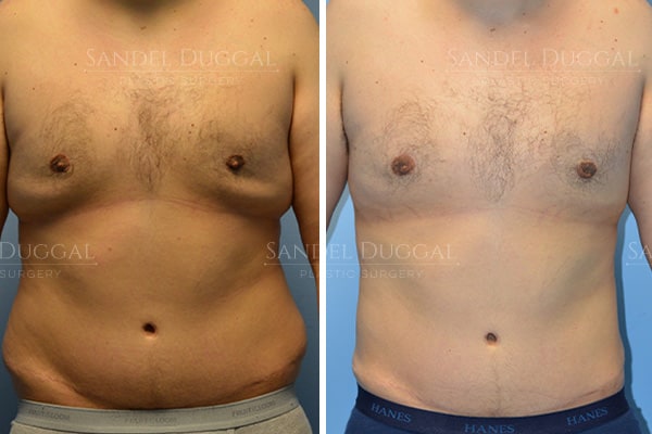 Male liposuction before and after, actual patient