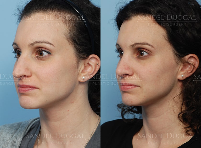 Rhinoplasty before and after, actual patient of Dr. Sandel