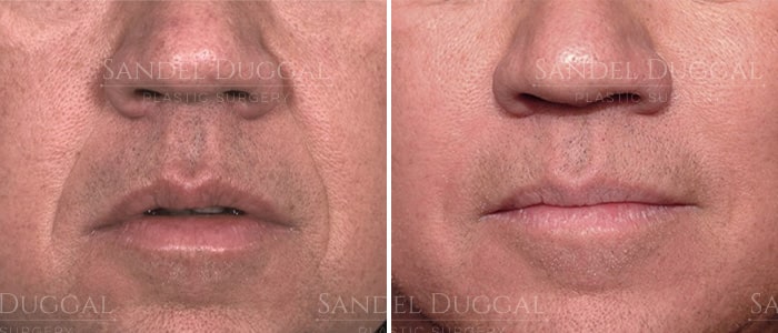 Dermal filler before and after, actual patient