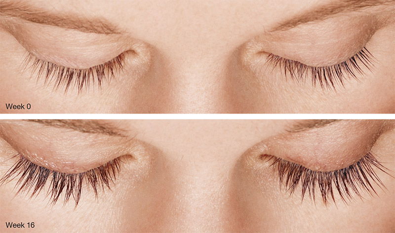 Latisse before and after, week 0 compared with week 16