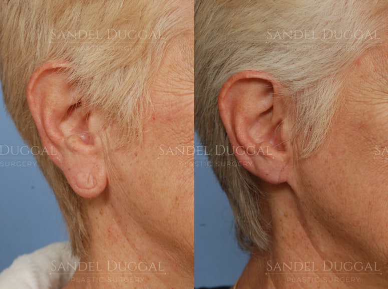 Earlobe reduction before and after, actual patient