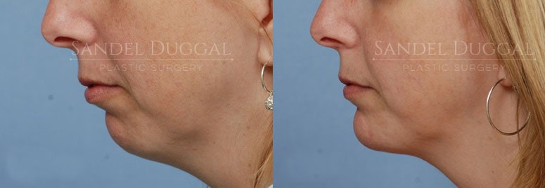 Chin implant before and after, actual patient of Dr. Sandel