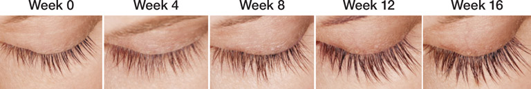 Latisse patient progression over the treatment course