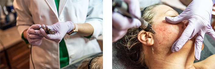 Microneedling treatment in progress at the medical spa