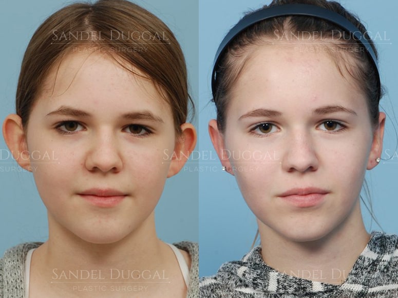 Otoplasty before and after, actual patient