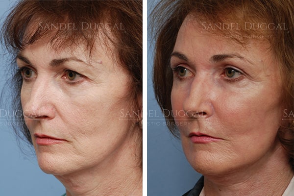 Cheek implants before and after, actual patient
