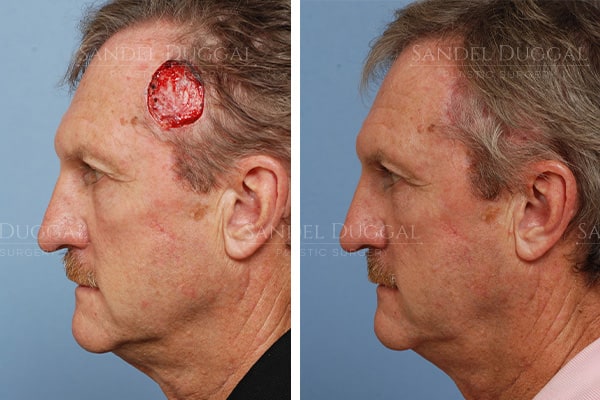 Forehead reconstruction before and after, actual patient
