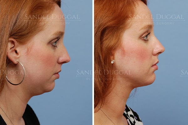 Chin and neck liposuction before and after, right profile, actual patient