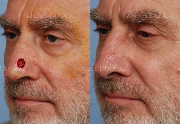 Mohs reconstruction before and after, actual patient