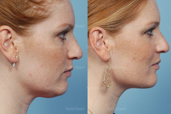 Double chin liposuction before and after, right profile, actual patient