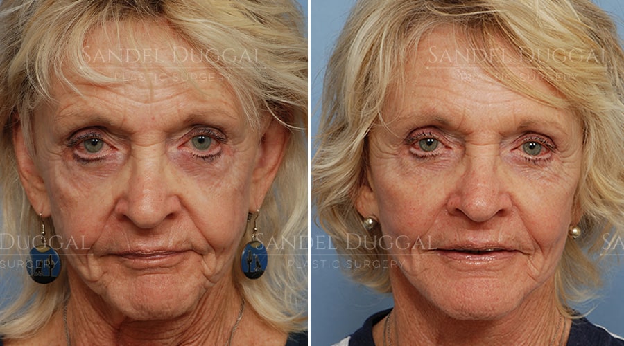 Cheek implant result, actual patient