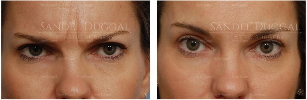 Botox before and after, female patient