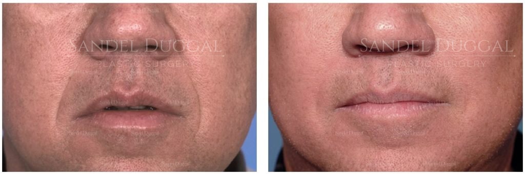 Botox before and after, male patient