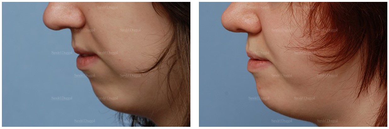 Chin augmentation before and after, side view, actual patient