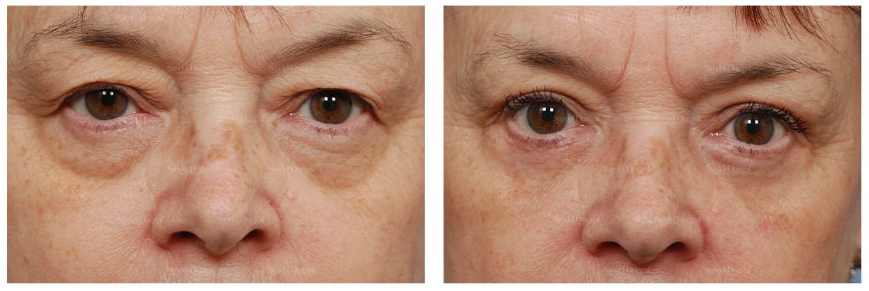 Eyelid surgery before and after — female patient