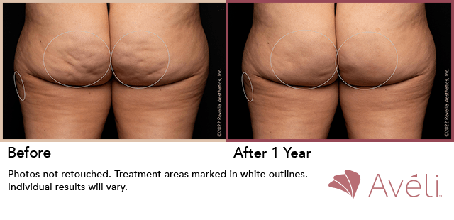 Avéli cellulite treatment, before and one year after, back view — manufacturer's clinical photograph