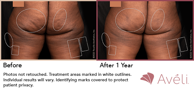 Avéli cellulite treatment, before and one year after — manufacturer's clinical photograph
