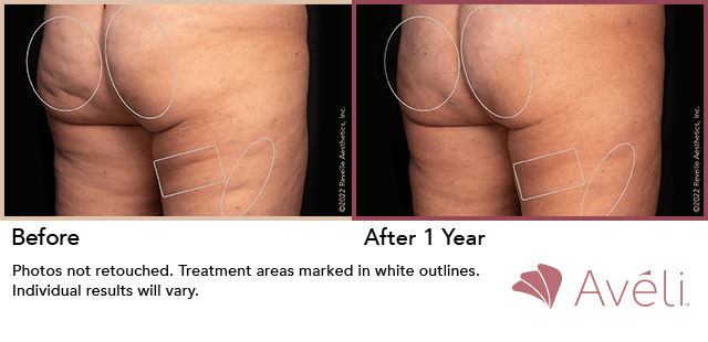 Avéli cellulite treatment, before and one year after, angle view — manufacturer's clinical photograph