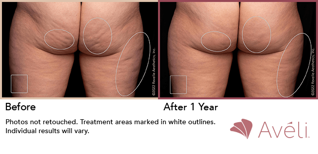 Avéli cellulite treatment, before and one year after, thighs and buttocks — manufacturer's clinical photograph