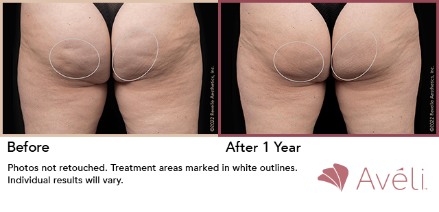 Avéli cellulite treatment, before and one year after, buttocks, back view — manufacturer's clinical photograph