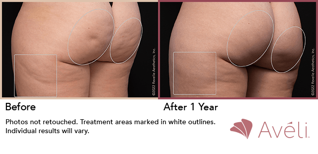 Avéli cellulite treatment, before and one year after, buttocks and thigh — manufacturer's clinical photograph