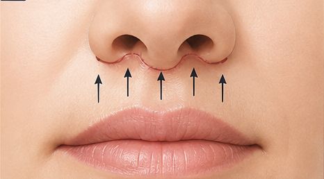 Step 04 — lip advancement
