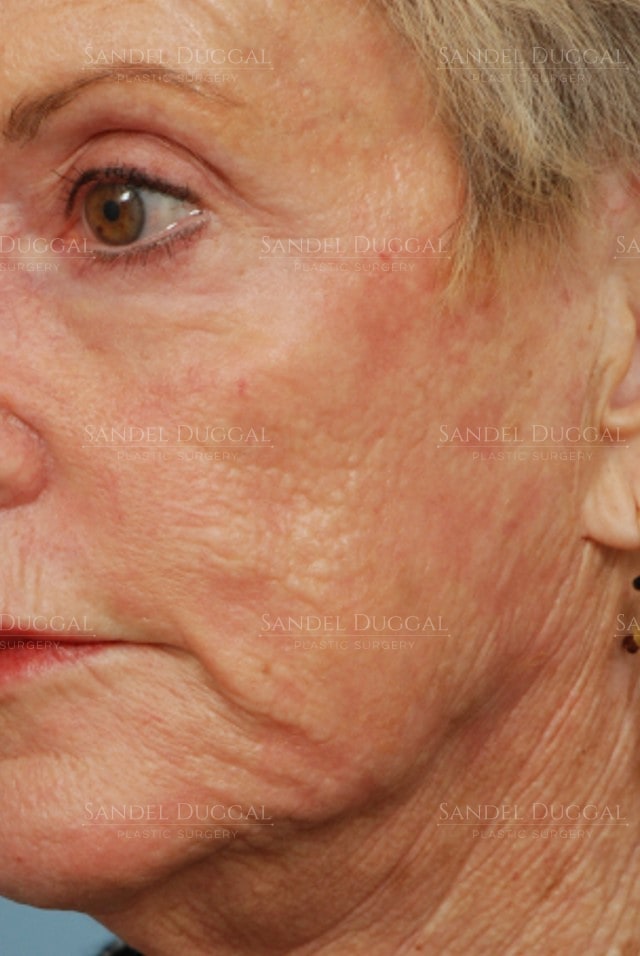 CO2 laser resurfacing after, three-quarter view — patient of Dr. Sandel